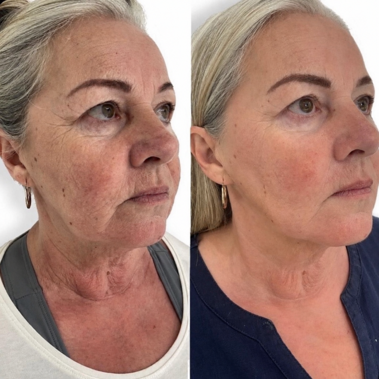 Before and after client photographs already featured on SKINN's Morpheus8 page