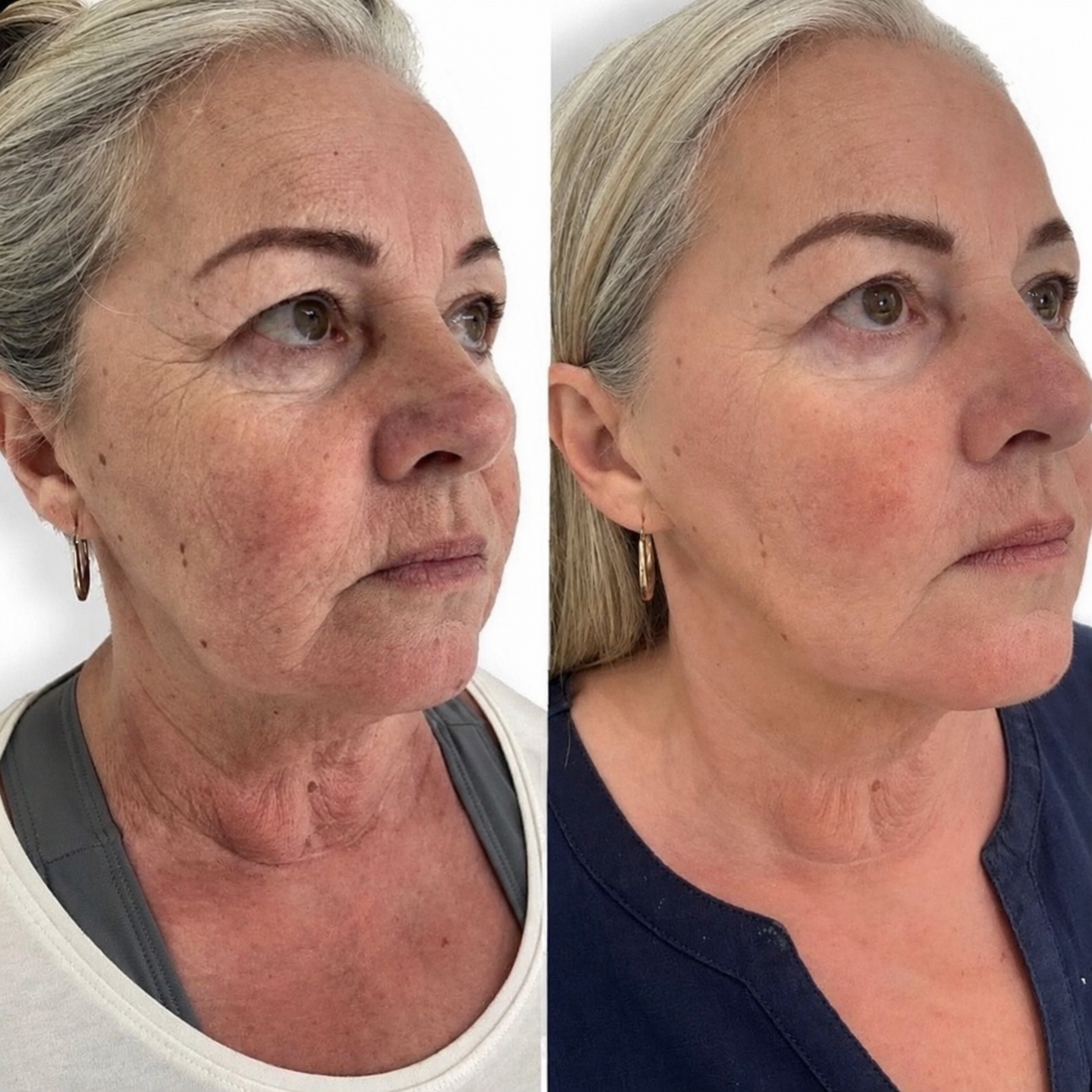 Before and after client photographs already featured on SKINN's Morpheus8 page